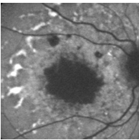 TUMOR INTRAOCULAR