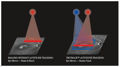 PRECISION EN CIRUGIA DE RETINA