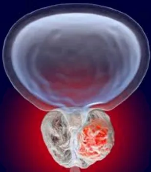 Imagen del artículo Cáncer de próstata