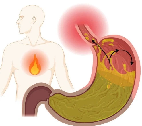 Imagen del artículo Reflujo gastroesofágico