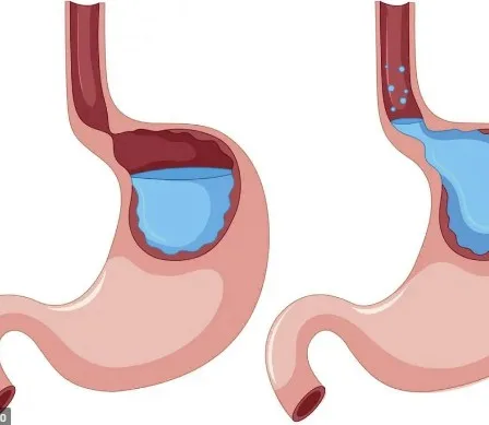 Imagen del artículo El reflujo gastroesofágico