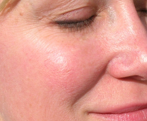 ROSACEA