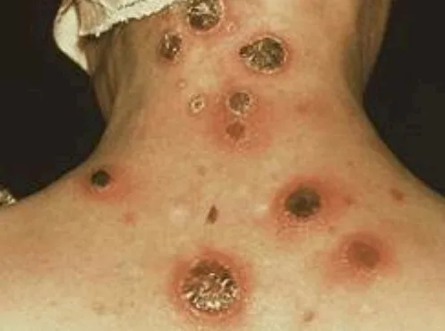 Imagen del artículo Cómo se pueden prevenir las enfermedades de transmisión sexual?