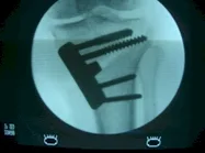 Imagen del artículo Trastornos de la rodilla