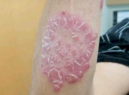 Imagen del artículo Psoriasis - Diagnostico y tratamiento