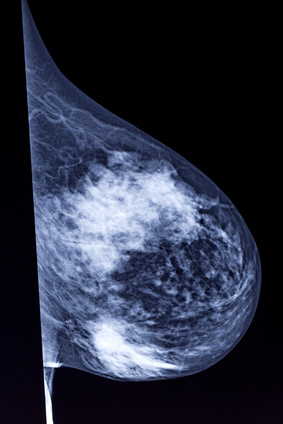 tumores en las mamas