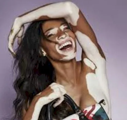Imagen del artículo Vitiligo