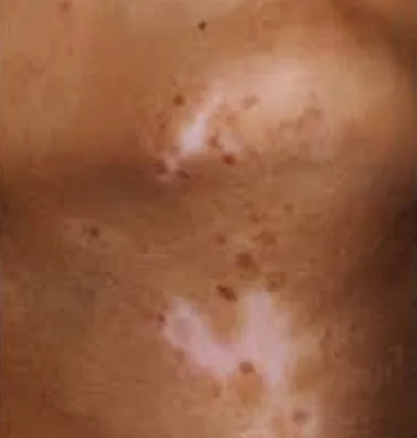 microfototerapia Guayaquil