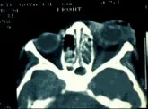 CELULITIS ORBITARIA