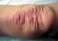 SINDROME DE EHLERS