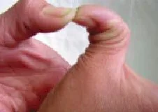 SINDROME DE EHLERS