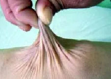 SINDROME DE EHLERS