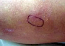 SINDROME DE EHLERS