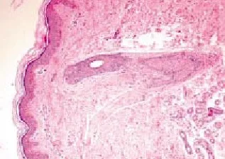 SINDROME DE EHLERS