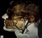 Angiofibroma nasofaringeo
