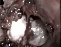 Angiofibroma nasofaringeo