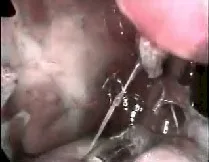 Angiofibroma nasofaringeo
