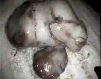 Angiofibroma nasofaringeo