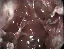 Angiofibroma nasofaringeo