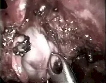 Angiofibroma nasofaringeo