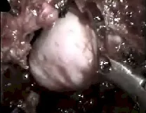 Angiofibroma nasofaringeo