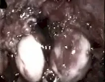 Angiofibroma nasofaringeo