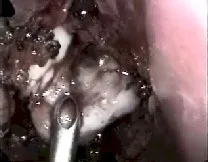 Angiofibroma nasofaringeo