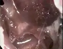 Angiofibroma nasofaringeo