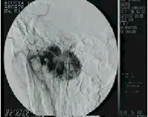 Angiofibroma nasofaringeo