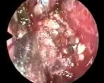 Angiofibroma nasofaringeo