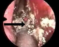 Angiofibroma nasofaringeo