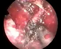 Angiofibroma nasofaringeo