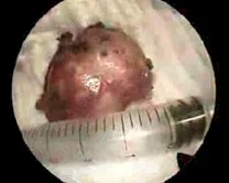 Angiofibroma nasofaringeo