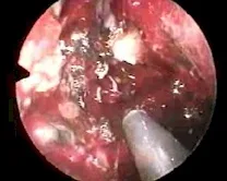 Angiofibroma nasofaringeo
