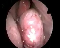 Angiofibroma nasofaringeo