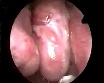 Angiofibroma nasofaringeo