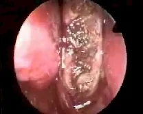 Angiofibroma nasofaringeo