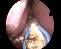 Angiofibroma nasofaringeo
