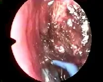 Angiofibroma nasofaringeo