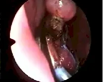 Angiofibroma nasofaringeo