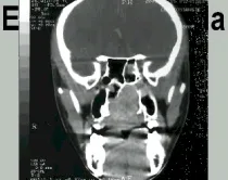 Angiofibroma nasofaringeo