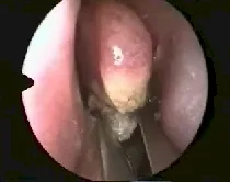 Angiofibroma nasofaringeo