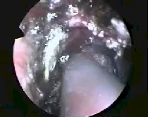 Angiofibroma nasofaringeo