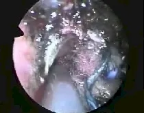 Angiofibroma nasofaringeo