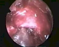 Angiofibroma nasofaringeo