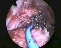 Angiofibroma nasofaringeo
