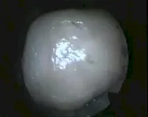Angiofibroma nasofaringeo