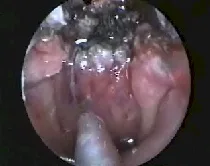 Angiofibroma nasofaringeo