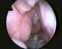 Angiofibroma nasofaringeo