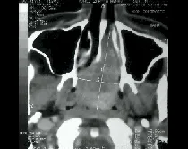 Angiofibroma nasofaringeo